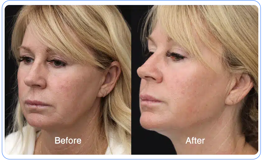 n1o1 before after 03