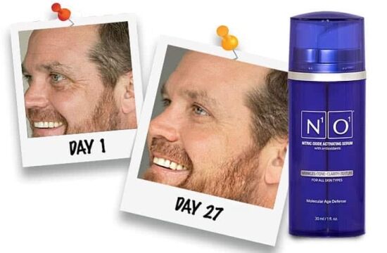 N1O1 Results Before & After